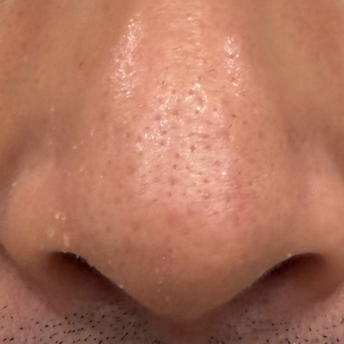 毛穴洗浄 施術前 鼻の毛穴・角栓（30代男性）