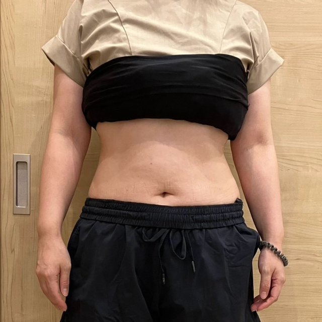 電磁パルス痩身 10回施術後 正面（腹部）
