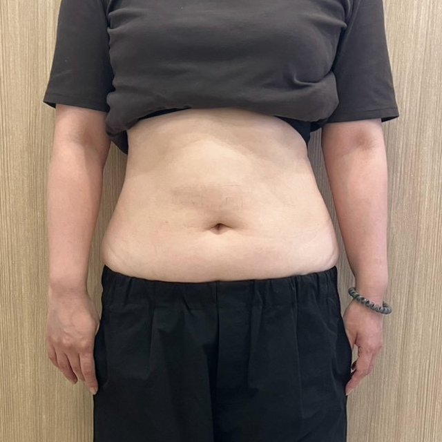 電磁パルス痩身 施術前 正面（腹部）