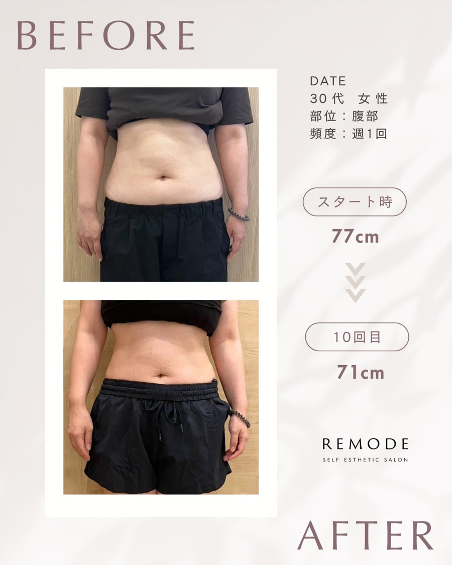 電磁パルス痩身 ビフォーアフター 30代女性 腹部 週1回10回 ウエスト77cm→71cm